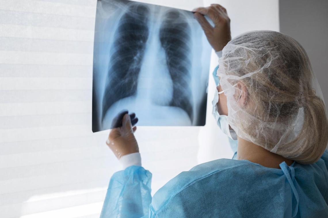 aumentan-un-65-los-casos-de-tuberculosis-en-argentina-la-situacion-es-alarmante Aumentan un 65% los casos de tuberculosis en Argentina: la situación es alarmante