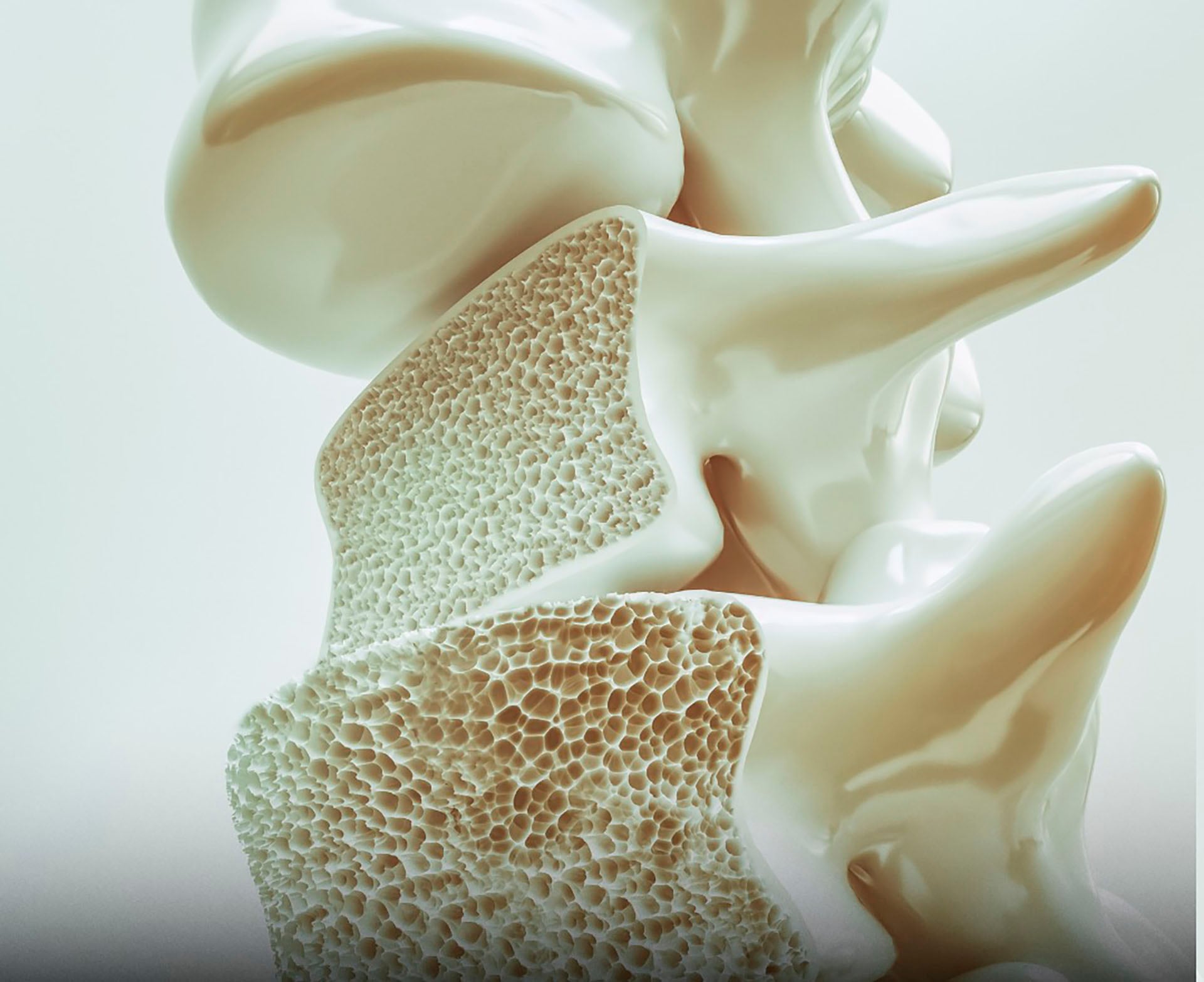 Más de dos millones de fracturas óseas anuales en Estados Unidos están relacionadas con la baja densidad mineral producto de la osteoporosis