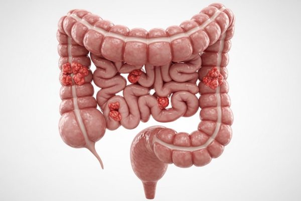 El cáncer colorrectal se convirtió en la principal causa de muerte oncológica en menores de 50 años en EE.UU.