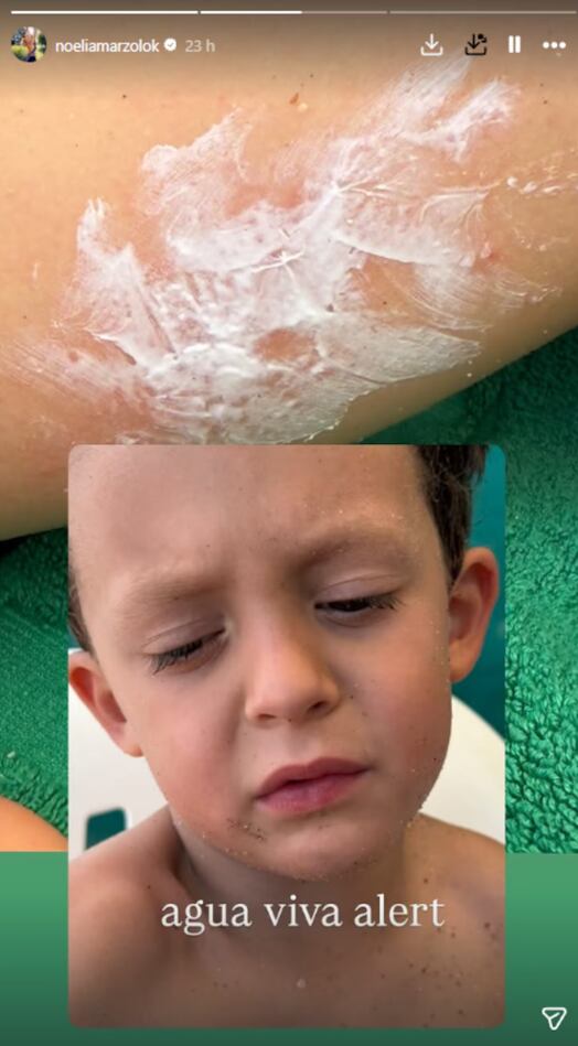 La bailarina mostró cómo resolvió la situación luego de que Donatello fuera picado