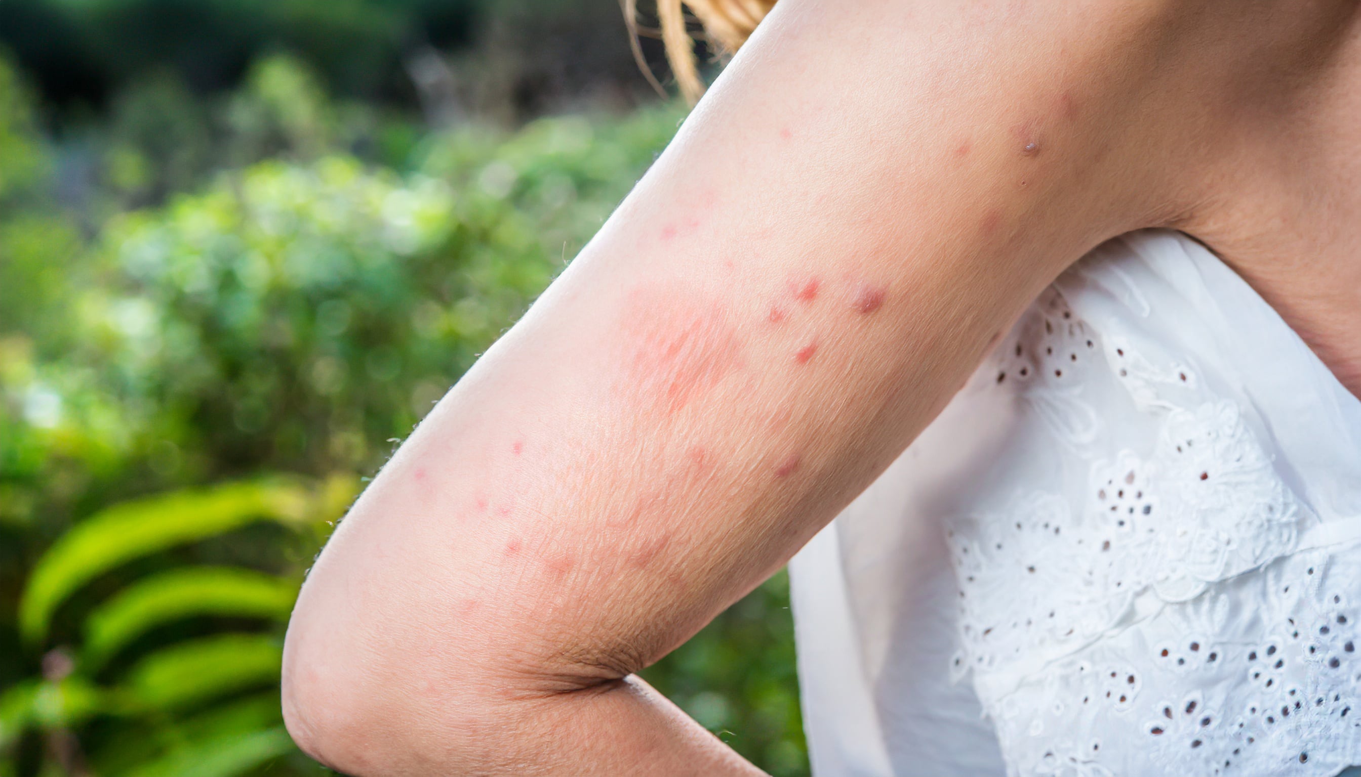 La herida del barigüí puede infectarse si la persona se rasca, lo que facilita la entrada de bacterias y complicando la recuperación (Imagen Ilustrativa Infobae)