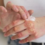 Qué es y cómo se trata la psoriasis, la enfermedad que tiene Miriam Lanzoni