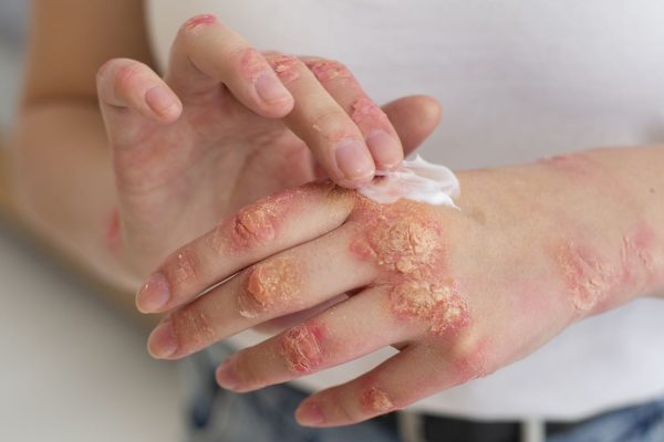 Qué es y cómo se trata la psoriasis, la enfermedad que tiene Miriam Lanzoni