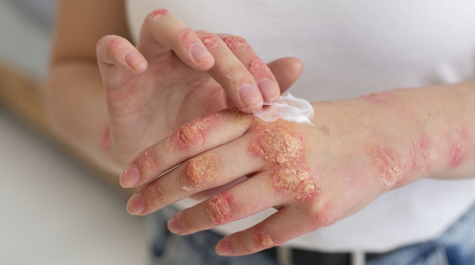 Qué es y cómo se trata la psoriasis, la enfermedad que tiene Miriam Lanzoni