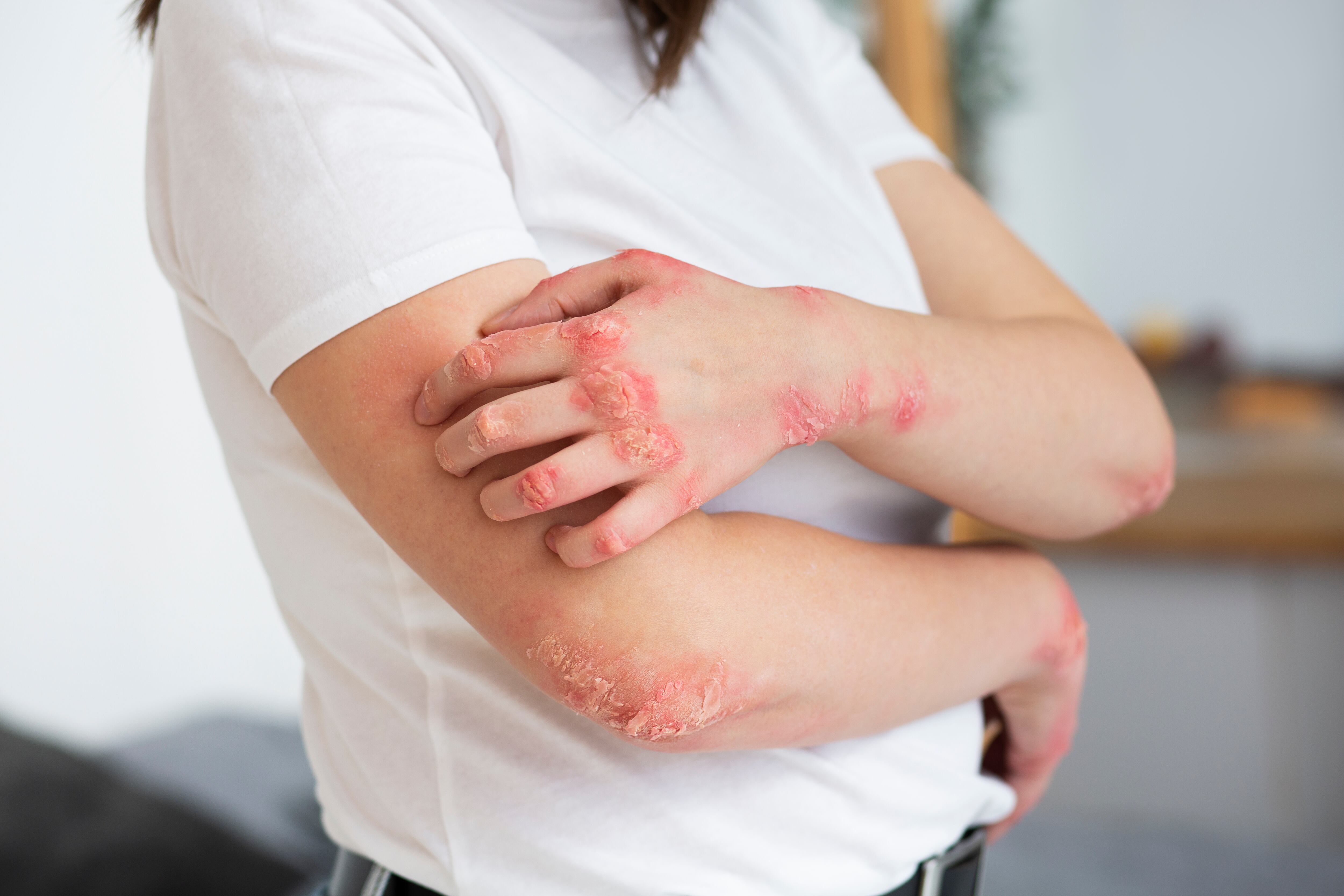 La psoriasis se manifiesta en brotes que alteran el bienestar físico y emocional, afecta entre el 2 y el 3% de la población argentina, según el Hospital de Clínicas (Freepik)