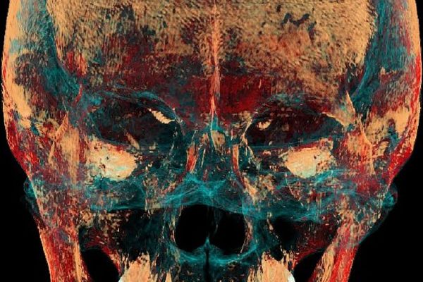 Científicos hallaron evidencia de una operación de mandíbula de hace 2.500 años