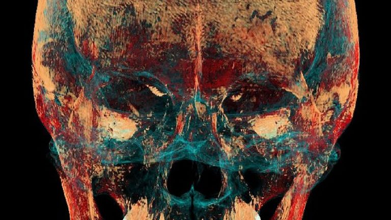 Científicos hallaron evidencia de una operación de mandíbula de hace 2.500 años