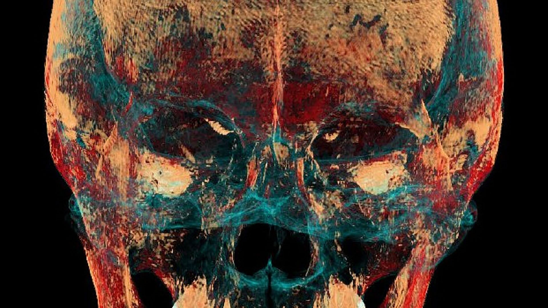 Científicos hallaron evidencia de una operación de mandíbula de hace 2.500 años