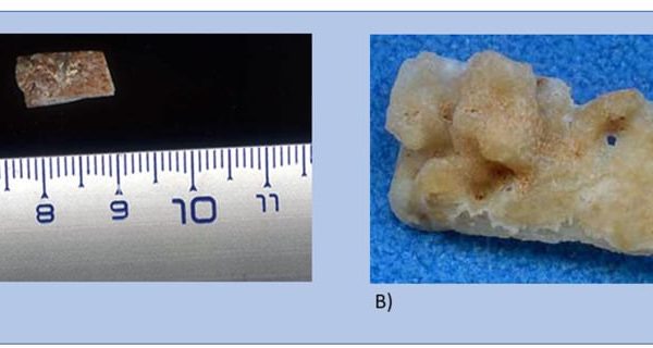 Descubrieron en Grecia un cráneo humano de casi 300.000 años que no es Homo sapiens ni neandertal