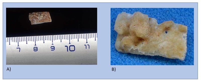 Descubrieron en Grecia un cráneo humano de casi 300.000 años que no es Homo sapiens ni neandertal