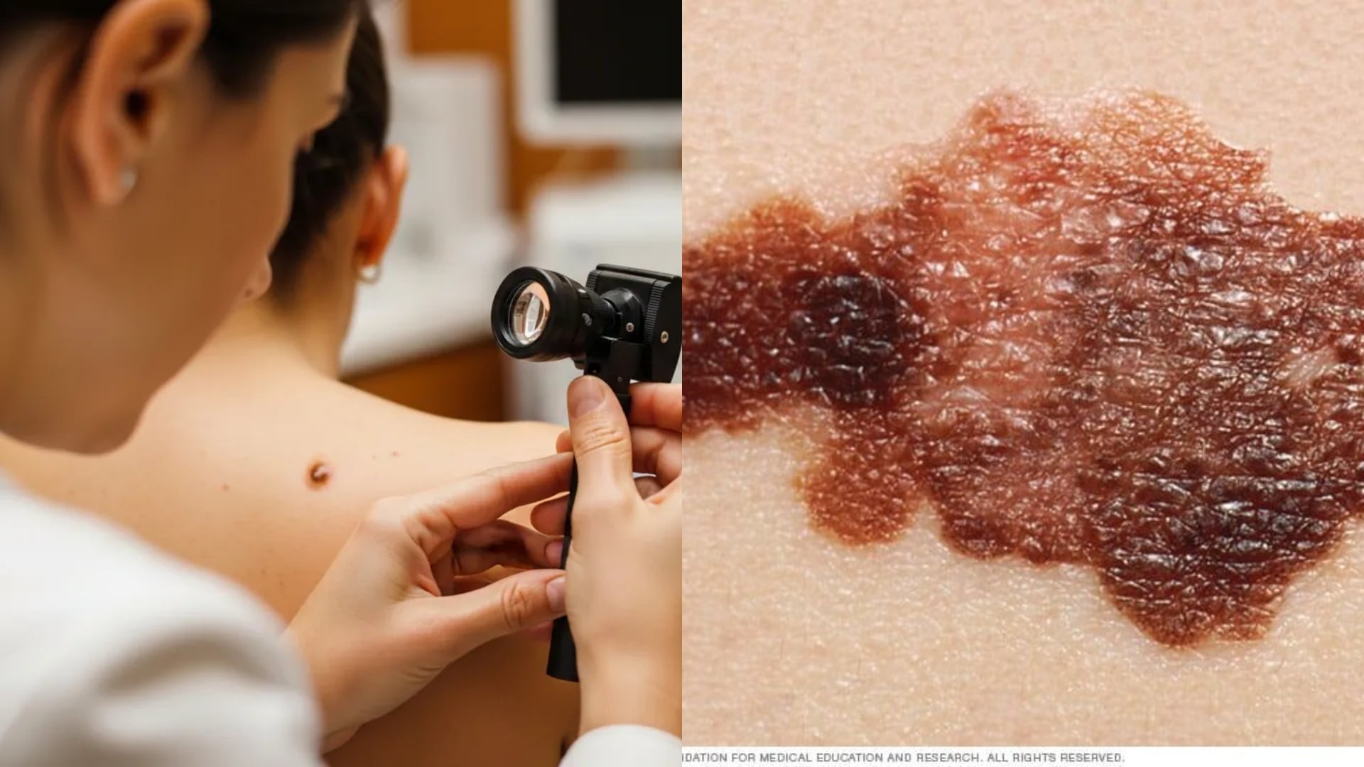 Lunares o manchas en la piel que podrían dar una detección temprana de cáncer de piel (RS)