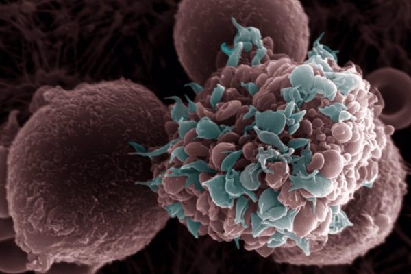 Un ensayo clínico mostró eficacia en una vacuna personalizada contra el cáncer de mama más agresivo