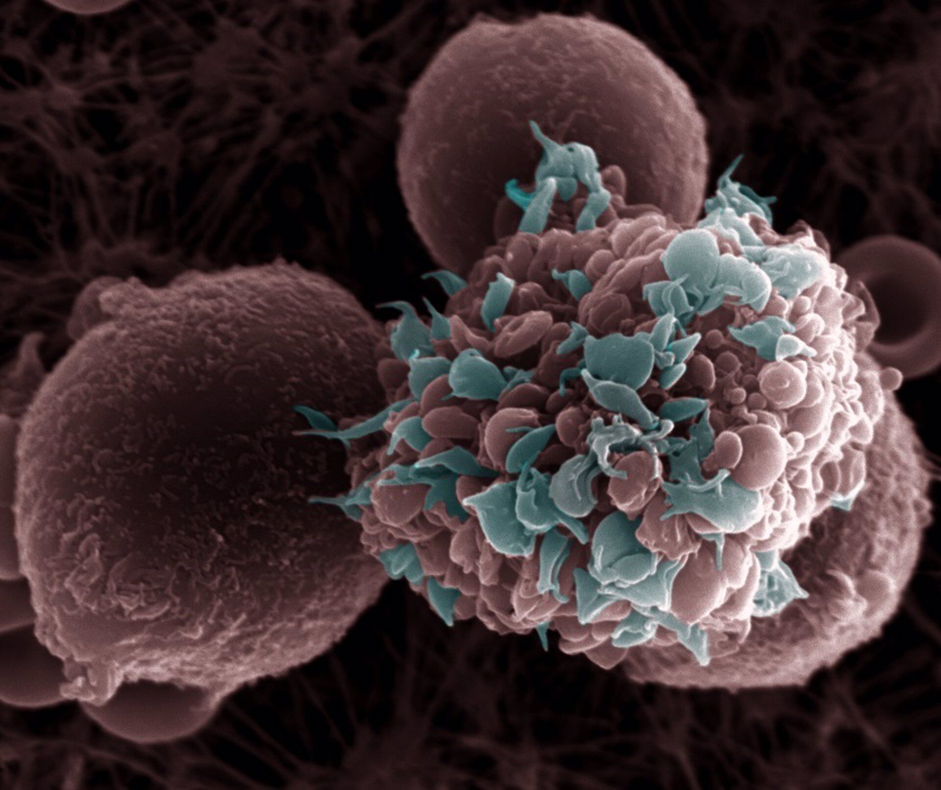 Un ensayo clínico mostró eficacia en una vacuna personalizada contra el cáncer de mama más agresivo