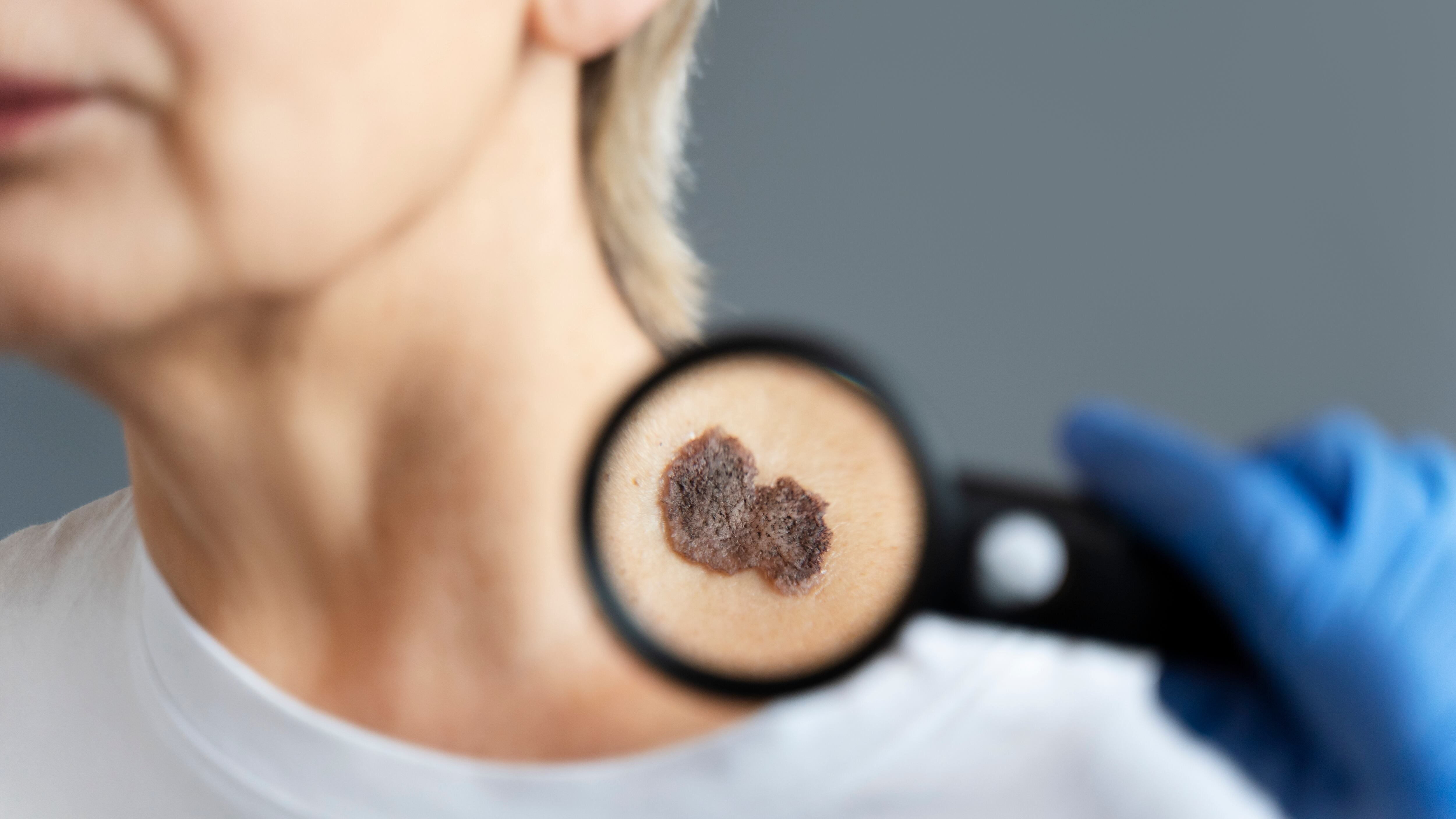 La detección temprana de melanoma en la piel aumenta las posibilidades de éxito en el tratamiento según expertos de la Cleveland Clinic