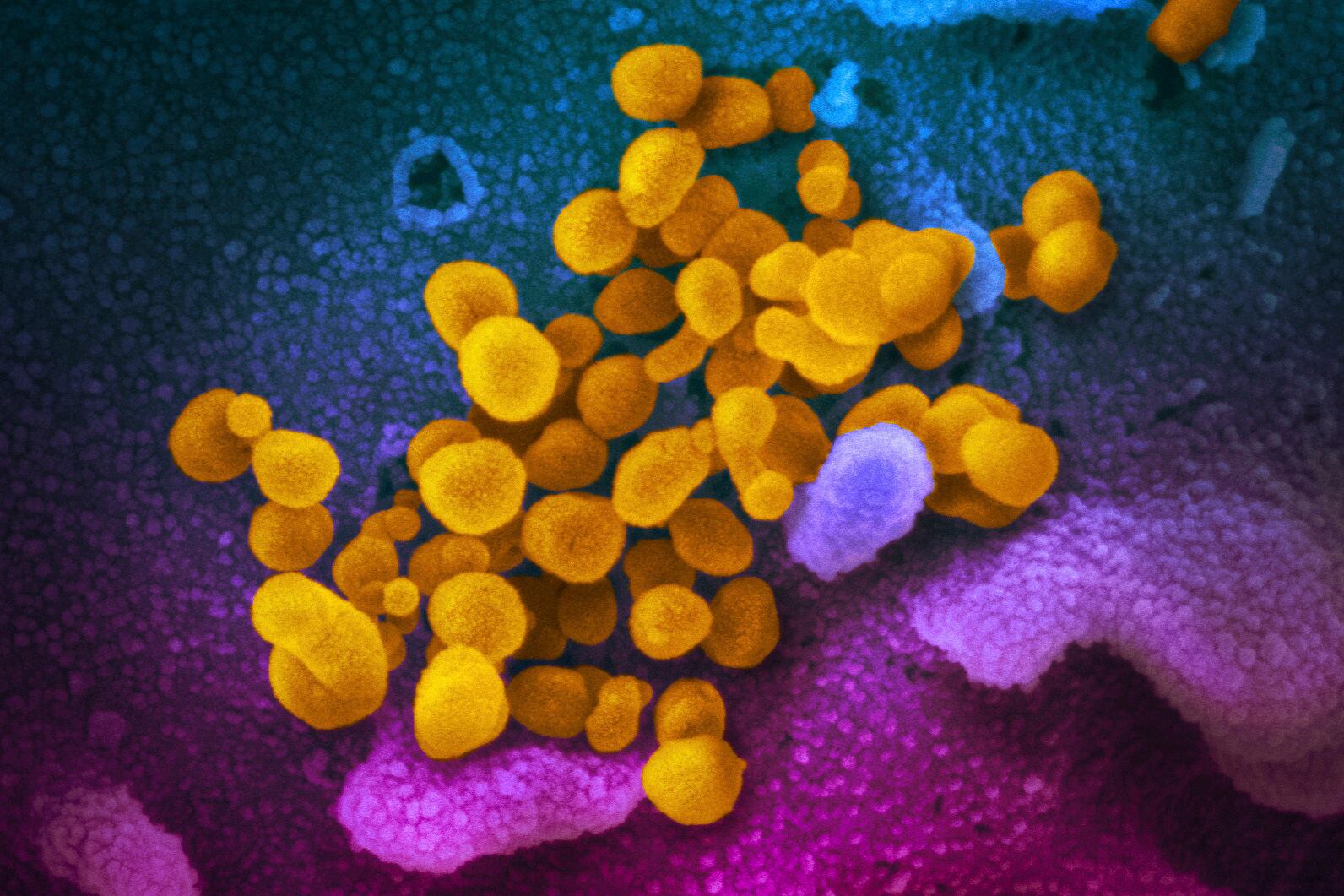 Células de coronavirus, indicadas en amarillo, saliendo de la superficie de células marcadas con azul y rosado, en esta foto de microscopio suministrada por los Institutos Nacionales de Salud de Estados Unidos, en febrero de 2020. (NIAID-RML via AP)