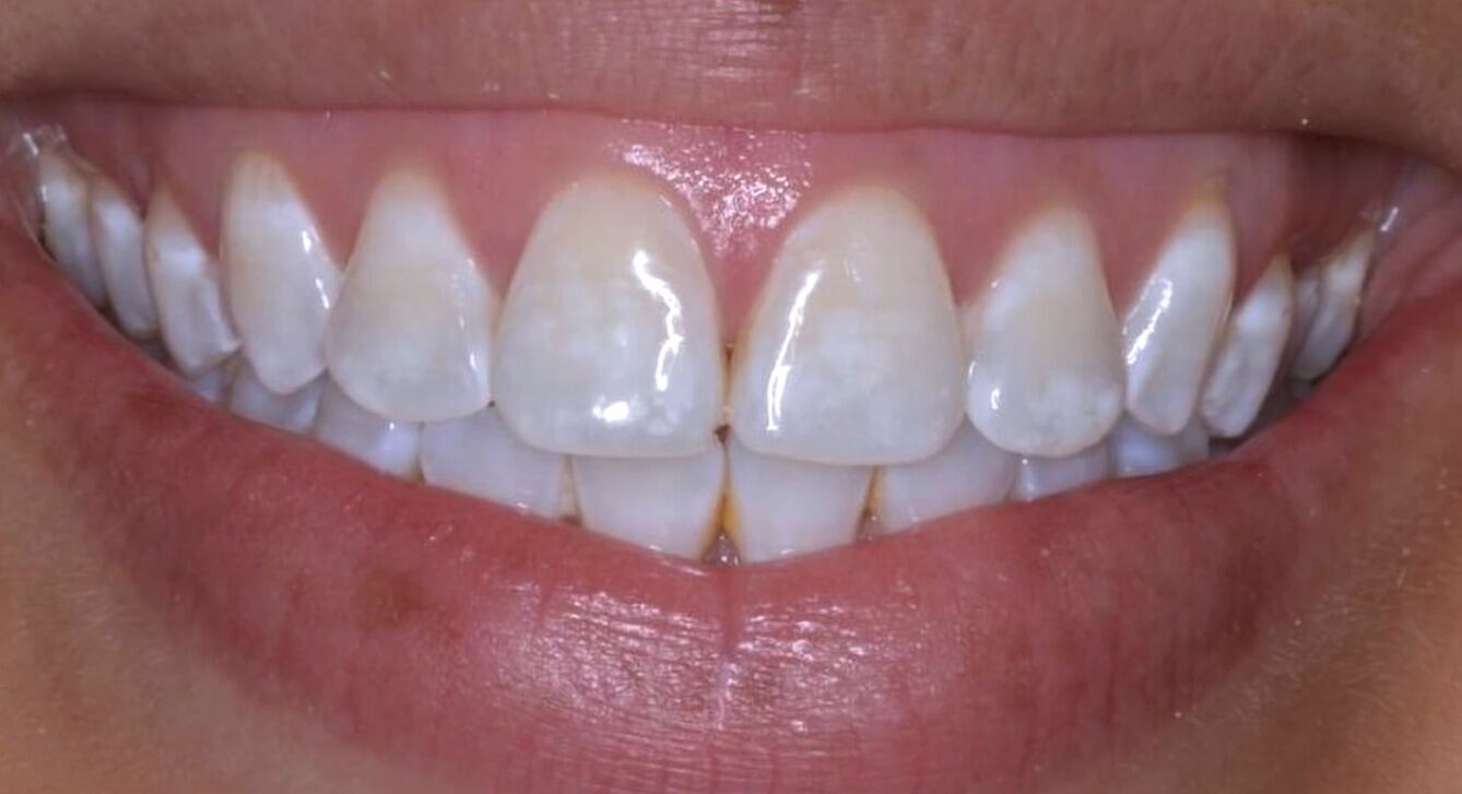 La fluorosis dental se manifiesta principalmente como vetas blancas leves en los dientes de los niños, según especialistas en salud bucal