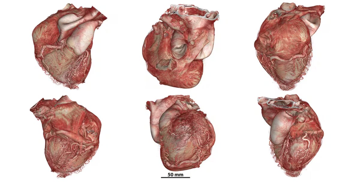 El atlas ya permitió identificar lesiones vasculares microscópicas en pulmones de pacientes fallecidos por covid, aportando nuevos hallazgos médicos (HOA) 