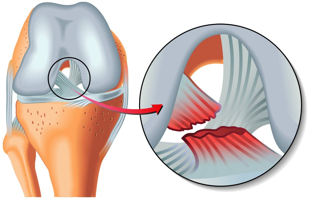 Kylin Shaw y Bhavy Metakar desarrollan una rodillera inteligente que utiliza inteligencia artificial para anticipar y evitar daños graves, integrando sistemas de alerta y bolsas de aire que actúan en milisegundos durante partidos y entrenamientos. (Imagen ilustrativa Infobae)