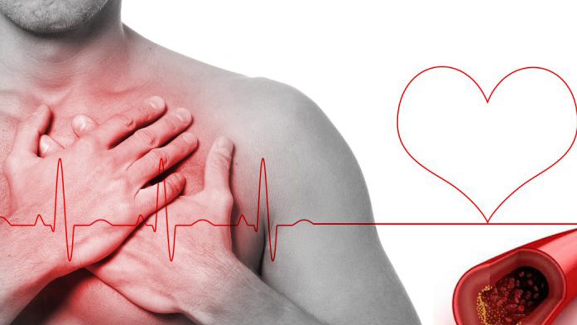 Las guías distinguen tres categorías de riesgo cardiovascular y establecen valores objetivos de LDL para cada una