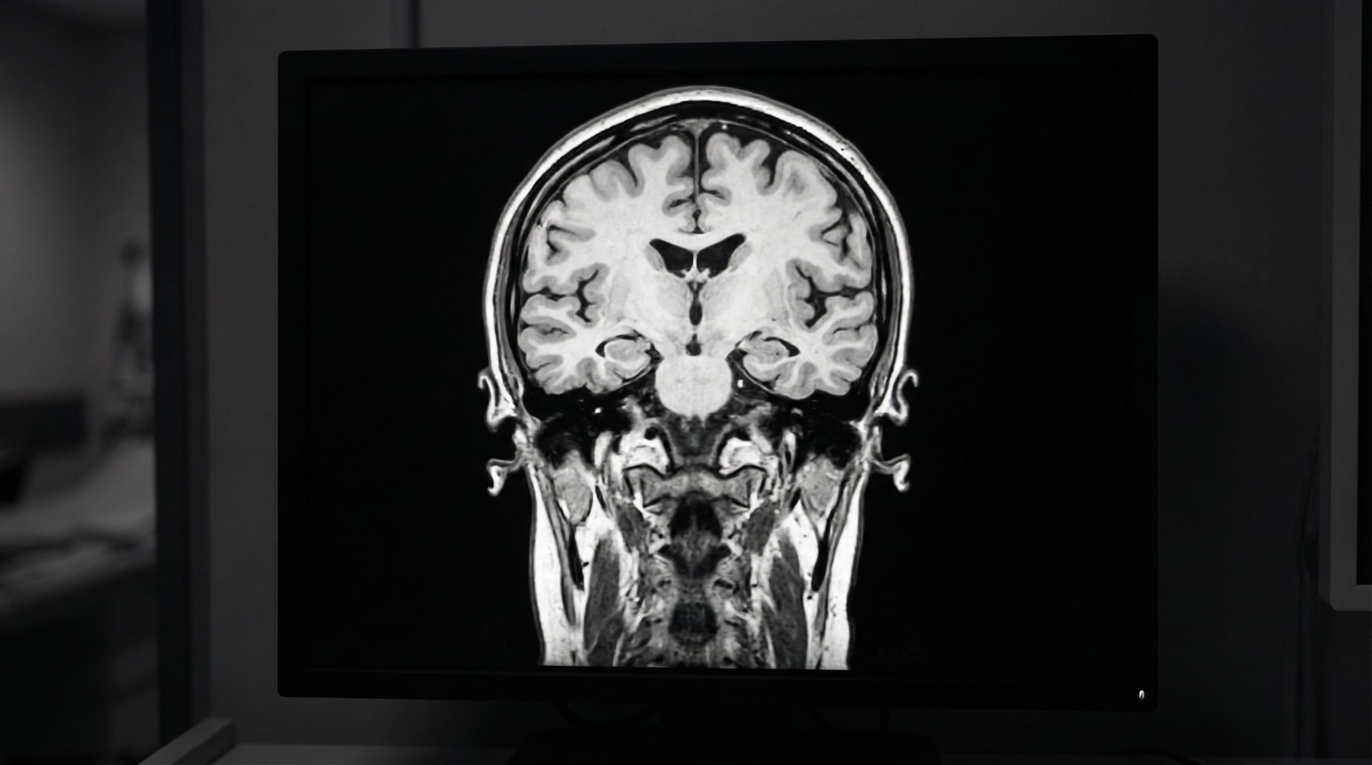 El antecedente familiar de Alzheimer y sus síntomas en edades similares justifican una consulta médica para detectar problemas de memoria a tiempo (Imagen Ilustrativa Infobae)