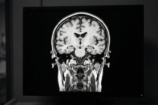 Cuáles son los 7 síntomas que anticipan enfermedades relacionadas con la memoria