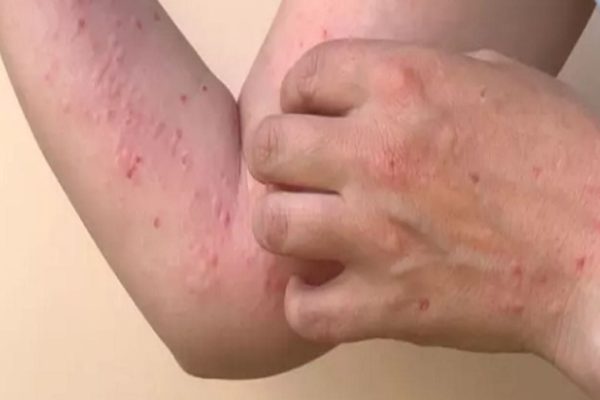 Cuáles son los síntomas de la variante más contagiosa de la “viruela del mono” que se detectó en Argentina