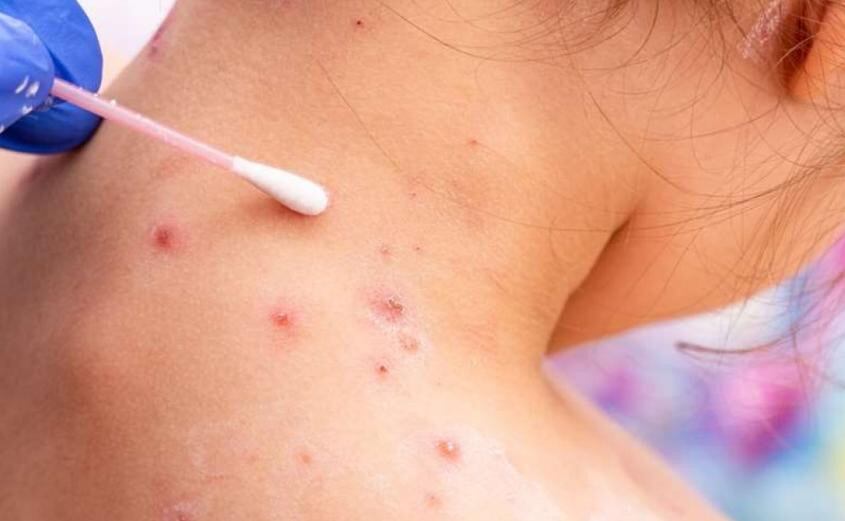 Las erupciones cutáneas, ampollas y llagas son los signos más visibles de la viruela del mono y pueden localizarse en distintas partes del cuerpo (Freepik) 