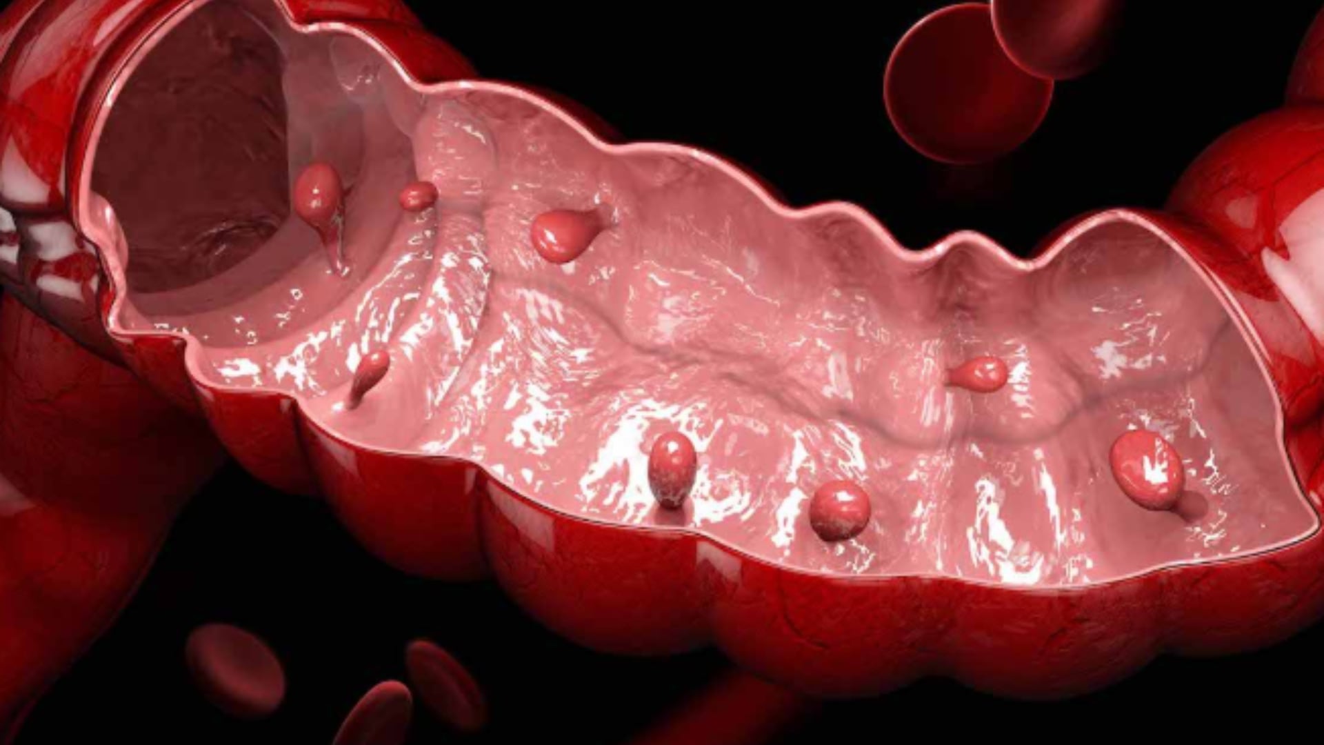 Investigadores de la Universidad de Flinders identificaron que casi el 50% de los pacientes con pólipos serrados presentan también adenomas, formando lesiones sincrónicas de alto riesgo (Roswel Park Institute)