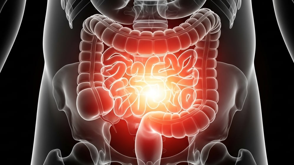 Sólo el 30% de las personas entre 50 y 75 años se realizan pruebas preventivas para cáncer de colon, lo que impacta negativamente en el diagnóstico (Imagen Ilustrativa Infobae)
