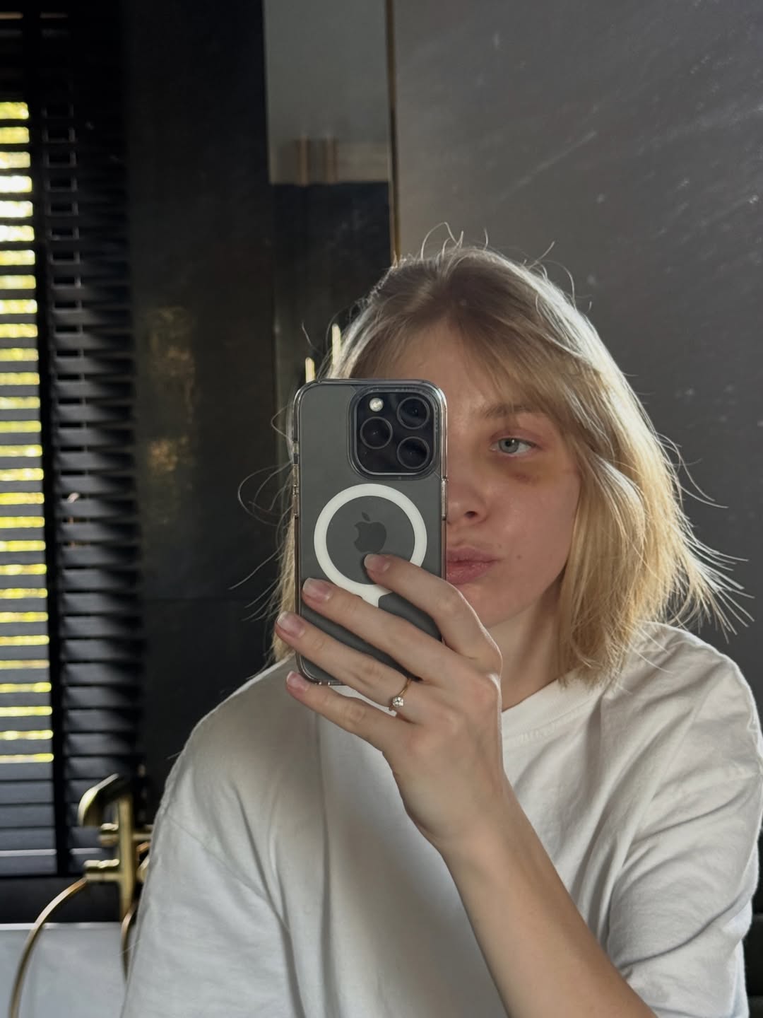 La patinadora polaca Kamila Sellier mostró la recuperación tras la operación en la órbita de su ojo izquierdo tras el accidente que sufrió en los Juegos Olímpicos de Invierno (Instagram)