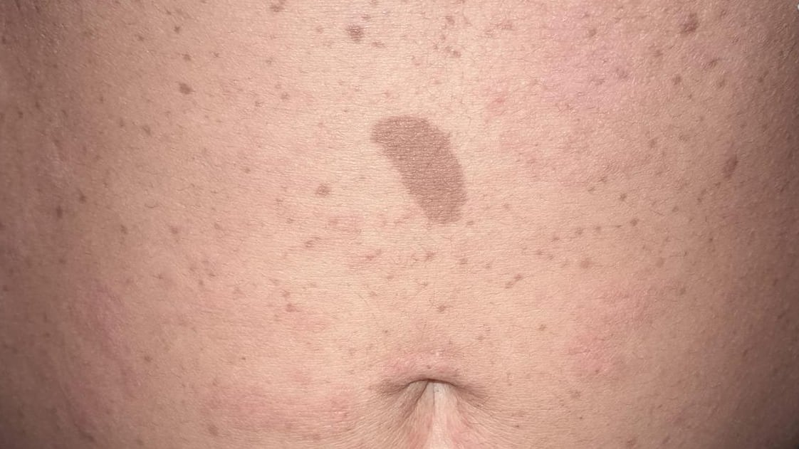 Manchas café con leche de una Neurofibromatosis (Cedigea UBA)