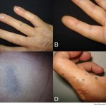 Enfermedades poco frecuentes de la piel: por qué los pacientes pueden tardar años en llegar al diagnóstico