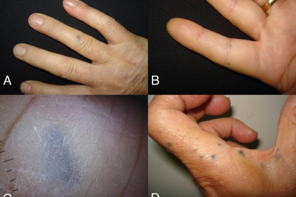 Enfermedades poco frecuentes de la piel: por qué los pacientes pueden tardar años en llegar al diagnóstico