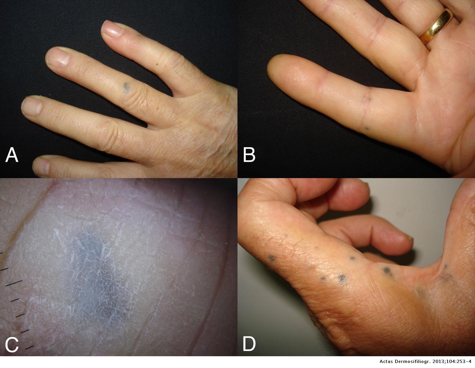 Enfermedades poco frecuentes de la piel: por qué los pacientes pueden tardar años en llegar al diagnóstico