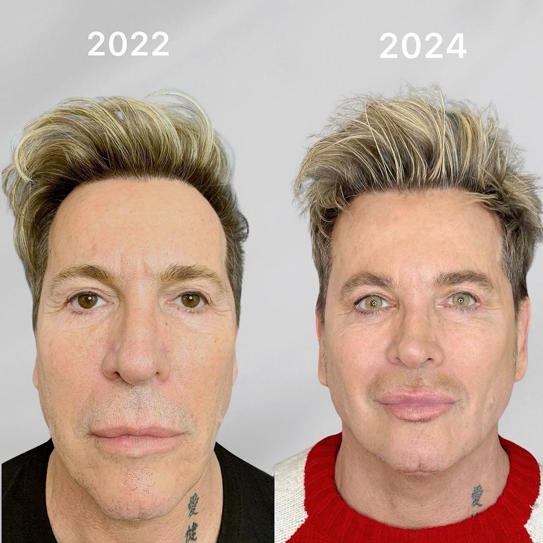 El antes y después del mediático luego de sus diferentes retoques estéticos (Instagram)