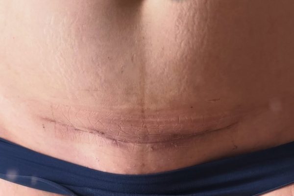 Juana Repetto mostró la cicatriz de su cesárea a casi un mes del parto: “El templo de mis tres hijos”