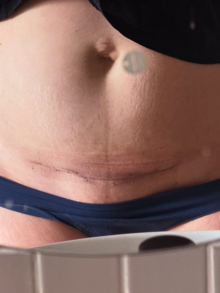 Juana Repetto mostró la cicatriz de su cesárea a casi un mes del parto: “El templo de mis tres hijos”