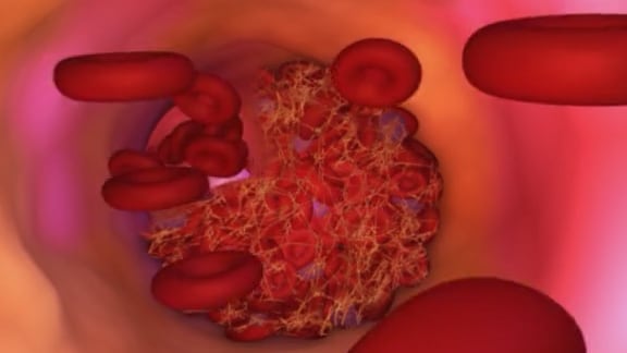 El colesterol LDL debe mantenerse bajo límites más estrictos según el nivel de riesgo ( Asociación Estadounidense del Corazón)