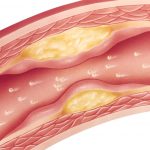 Nuevas guías sobre los valores del colesterol: cuáles son los límites sugeridos para evitar infartos y ACV