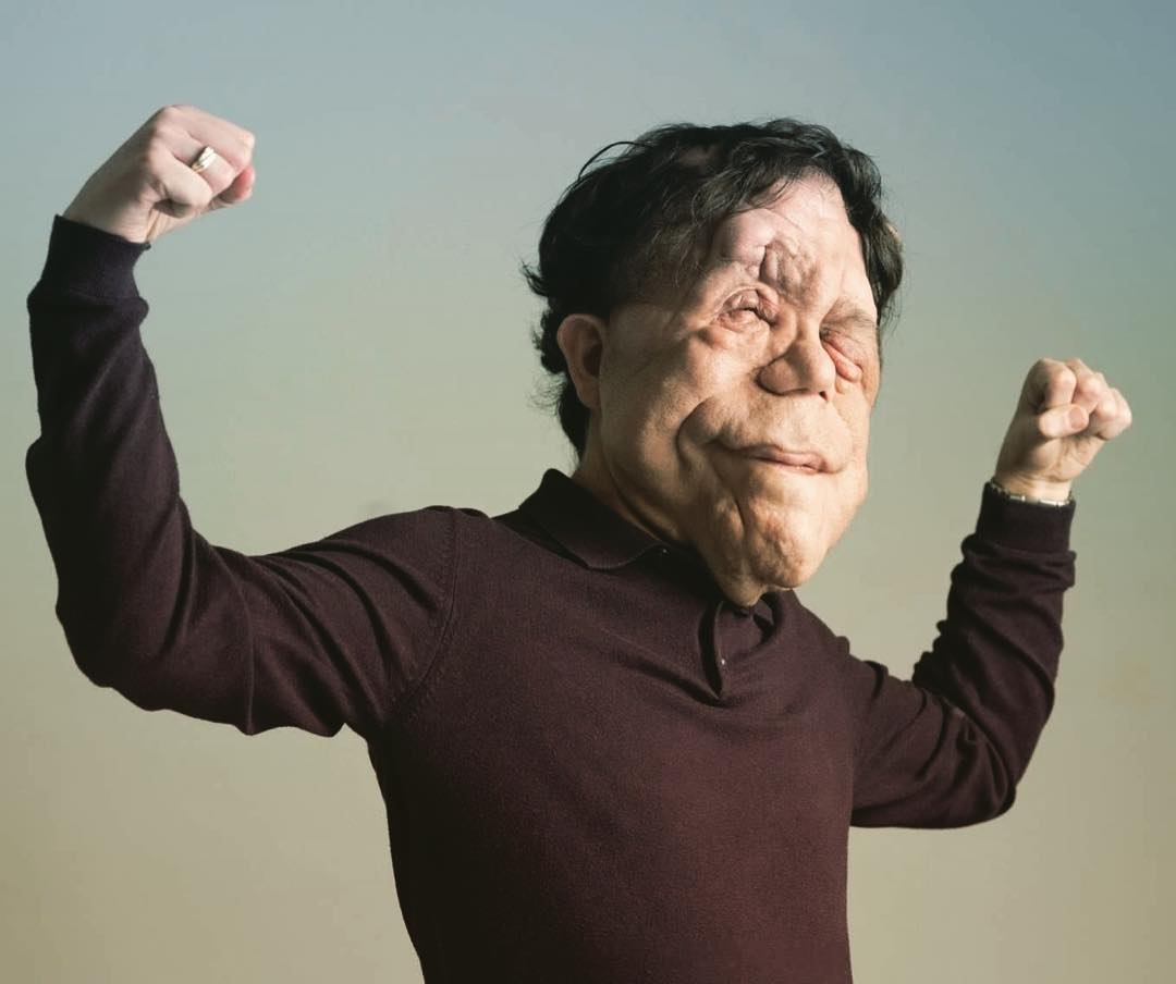 La neurofibromatosis tipo 1 es una enfermedad genética poco frecuente que afecta la piel y produce tumores benignos desde la infancia (Instagram/adam_pearson_tv)