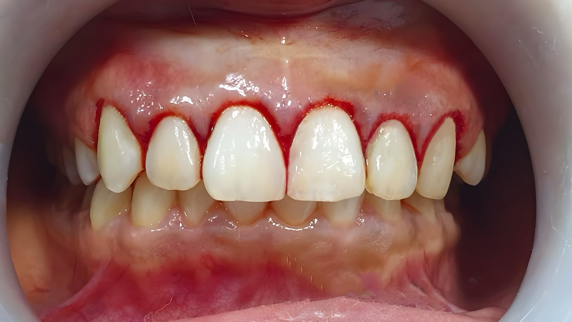 La enfermedad periodontal incrementa la inflamación general del organismo y eleva el riesgo cardiovascular y metabólico (Freepik)