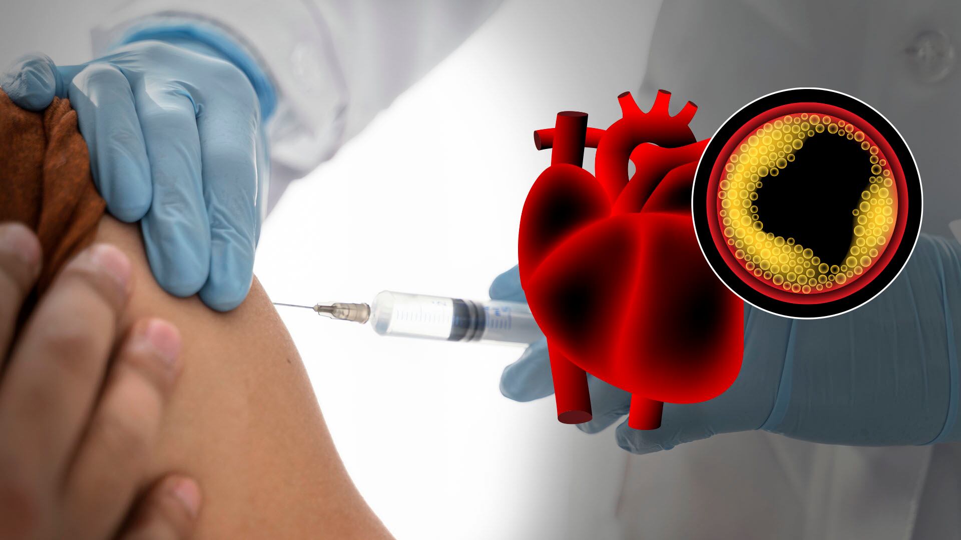 Inhibidores de PCSK9 inyectables presentan alta eficacia pero su costo limita su uso en sistemas de salud públicos