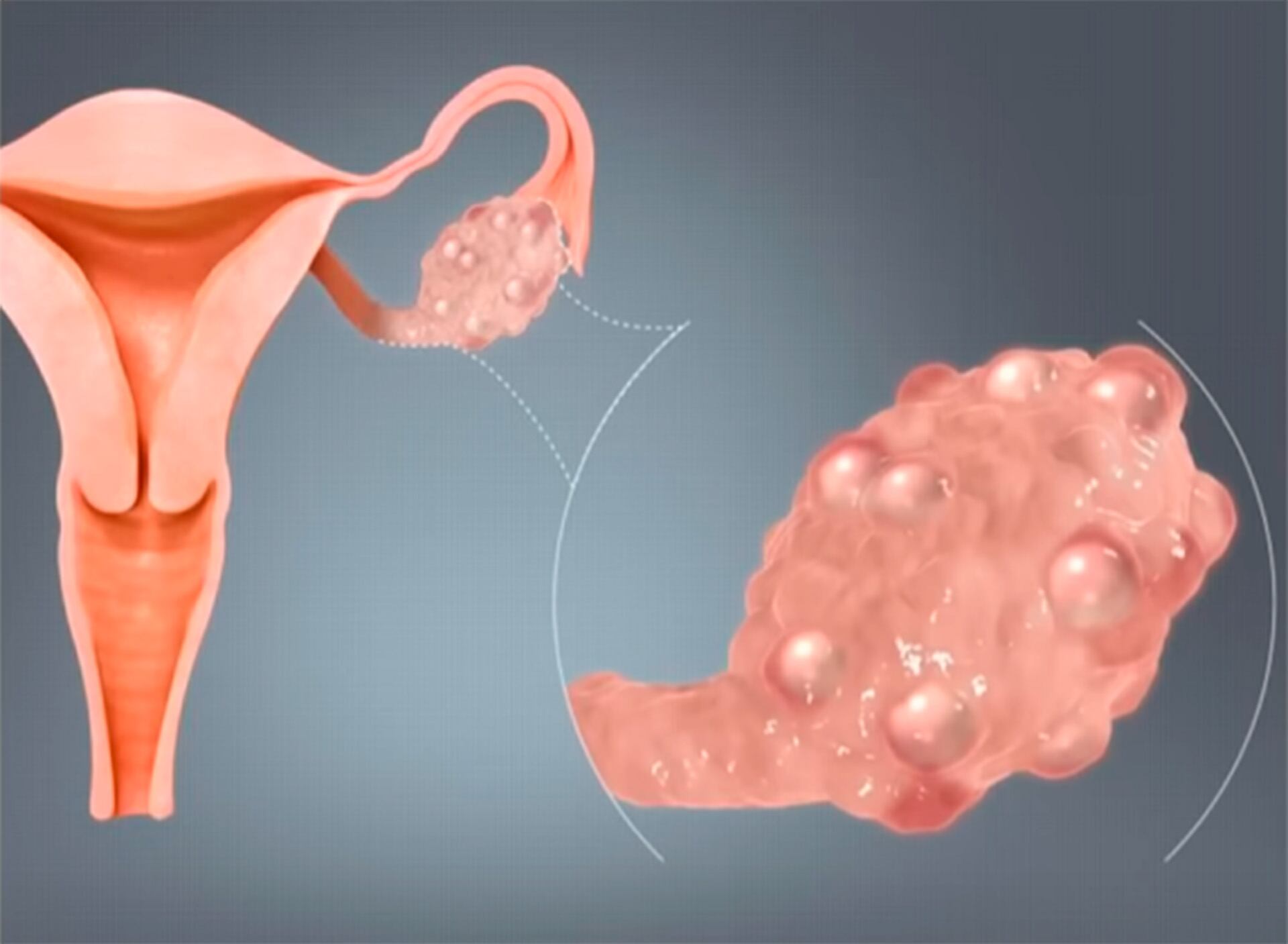 El síndrome de ovario poliquístico y la endometriosis son las principales causas de infertilidad femenina y sufren altos niveles de infradiagnóstico (Captura de video)