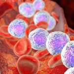 Una prueba genética puede predecir el riesgo de recaída de leucemia