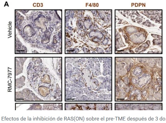 Las neoplasias intraepiteliales pancreáticas PanIN son lesiones frecuentes en adultos, pero solo una pequeña fracción se transforma en cáncer (Science)
