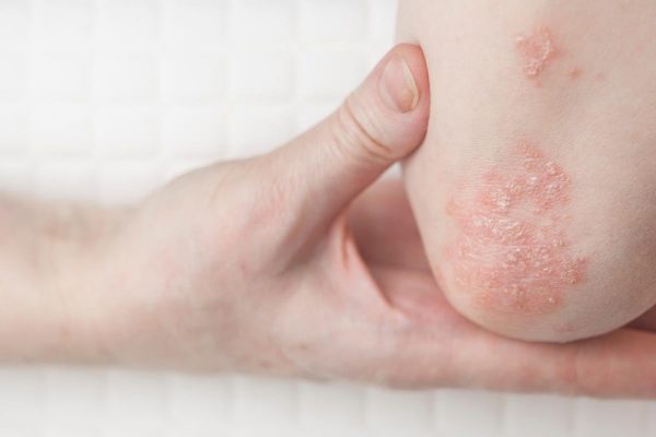 Las enfermedades autoinmunes como el lupus y la psoriasis pueden aumentar el riesgo de cáncer