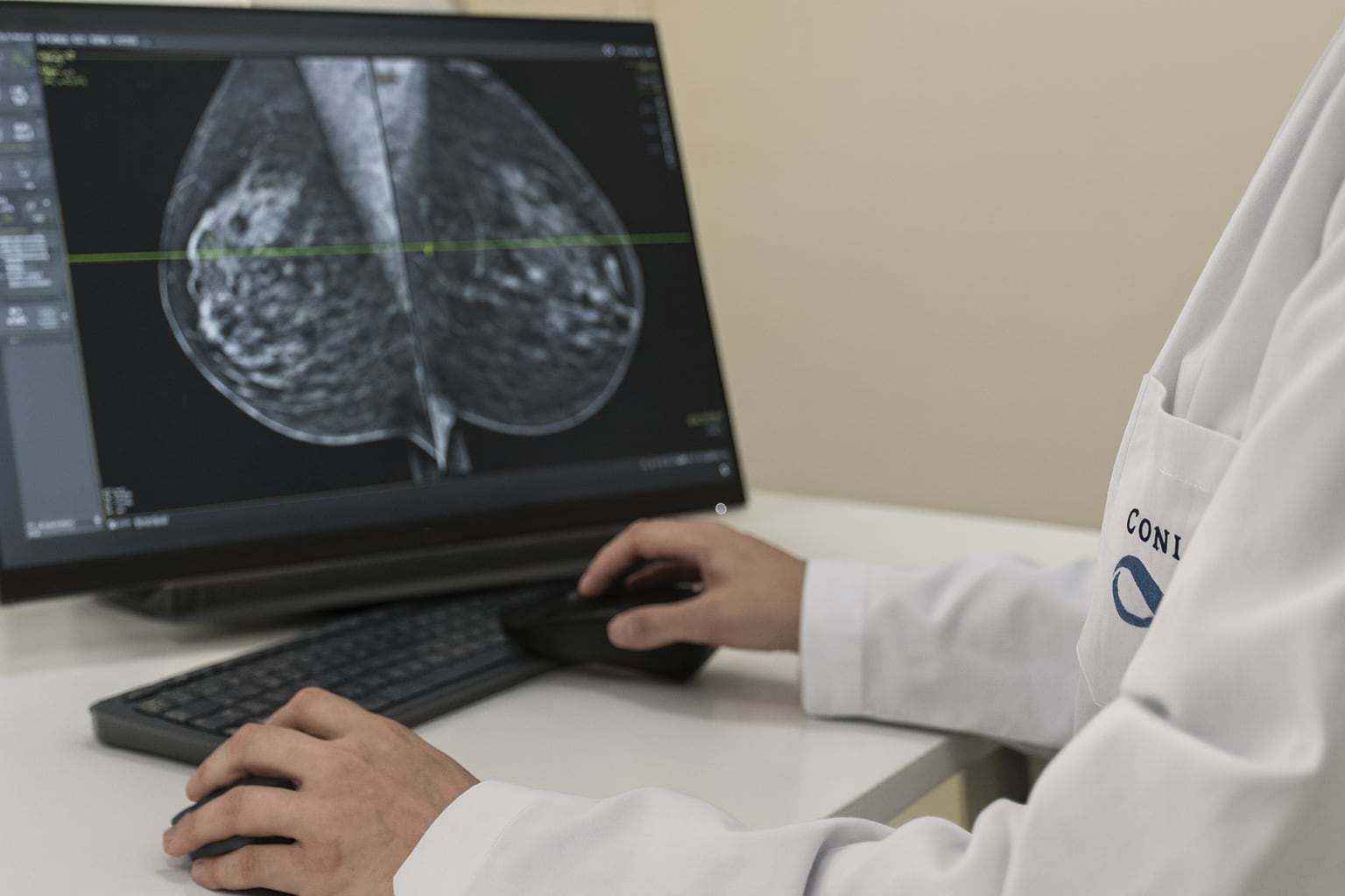 El cáncer de mama inflamatorio frecuentemente manifiesta enrojecimiento, engrosamiento o hoyuelos en la piel como síntomas principales
(Imagen Ilustrativa Infobae)