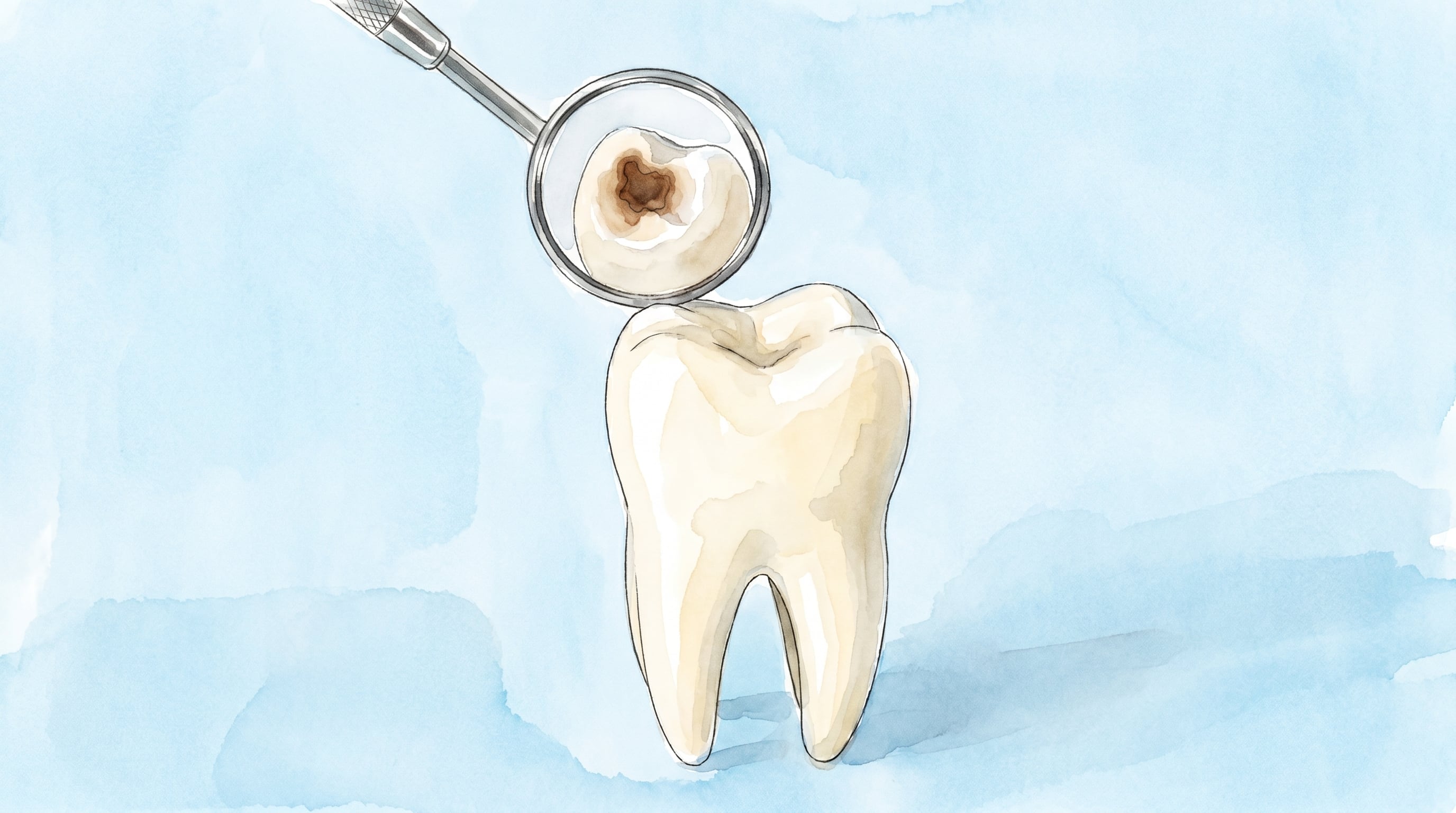 Una ilustración detallada muestra un diente con caries siendo examinado por un espejo dental, destacando la importancia del cuidado bucal y las revisiones periódicas. (Imagen Ilustrativa Infobae)