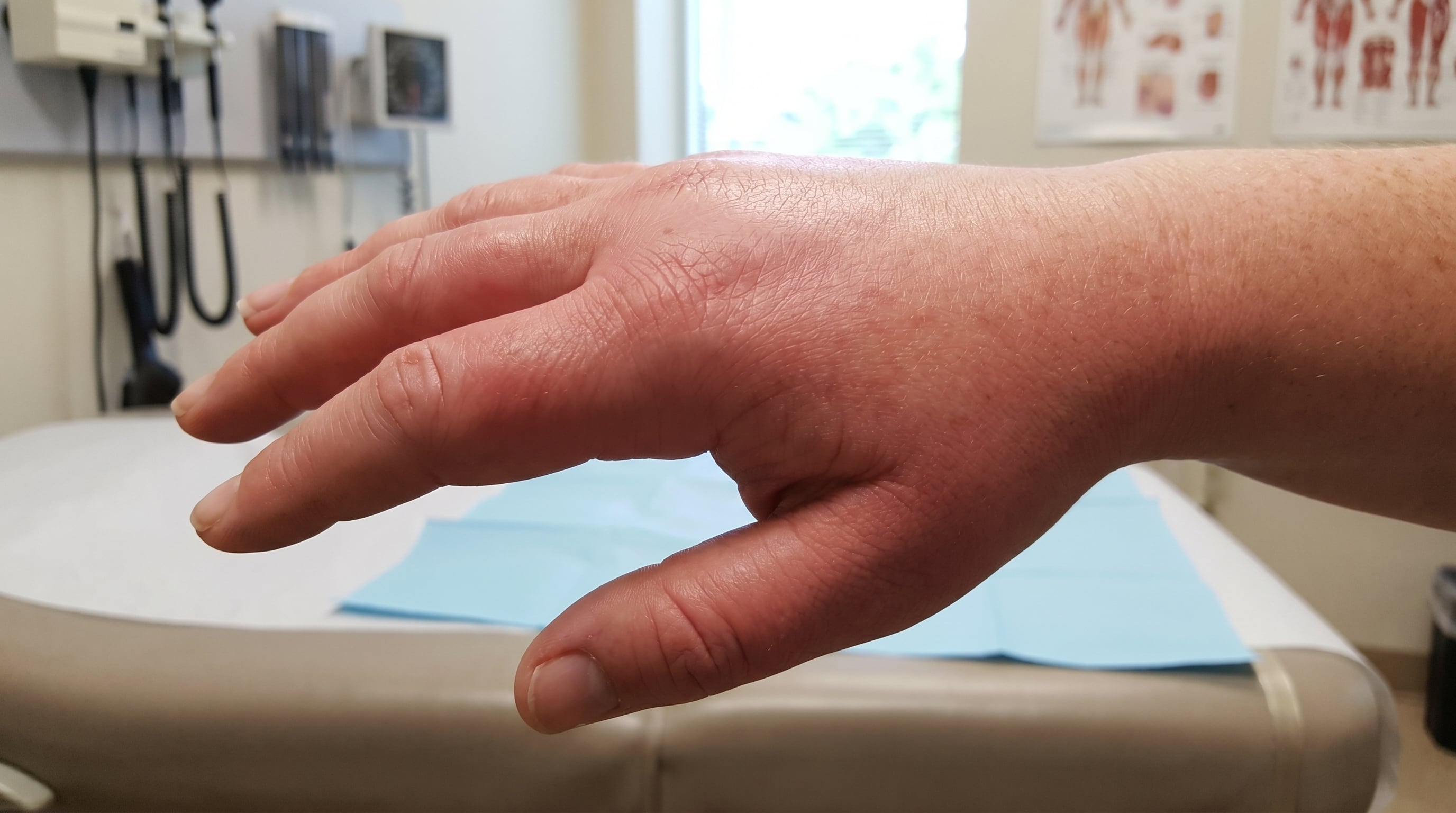 La hinchazón característica del angioedema hereditario puede poner en peligro la vida cuando afecta la garganta y causa riesgo de asfixia (Imagen Ilustrativa Infobae)