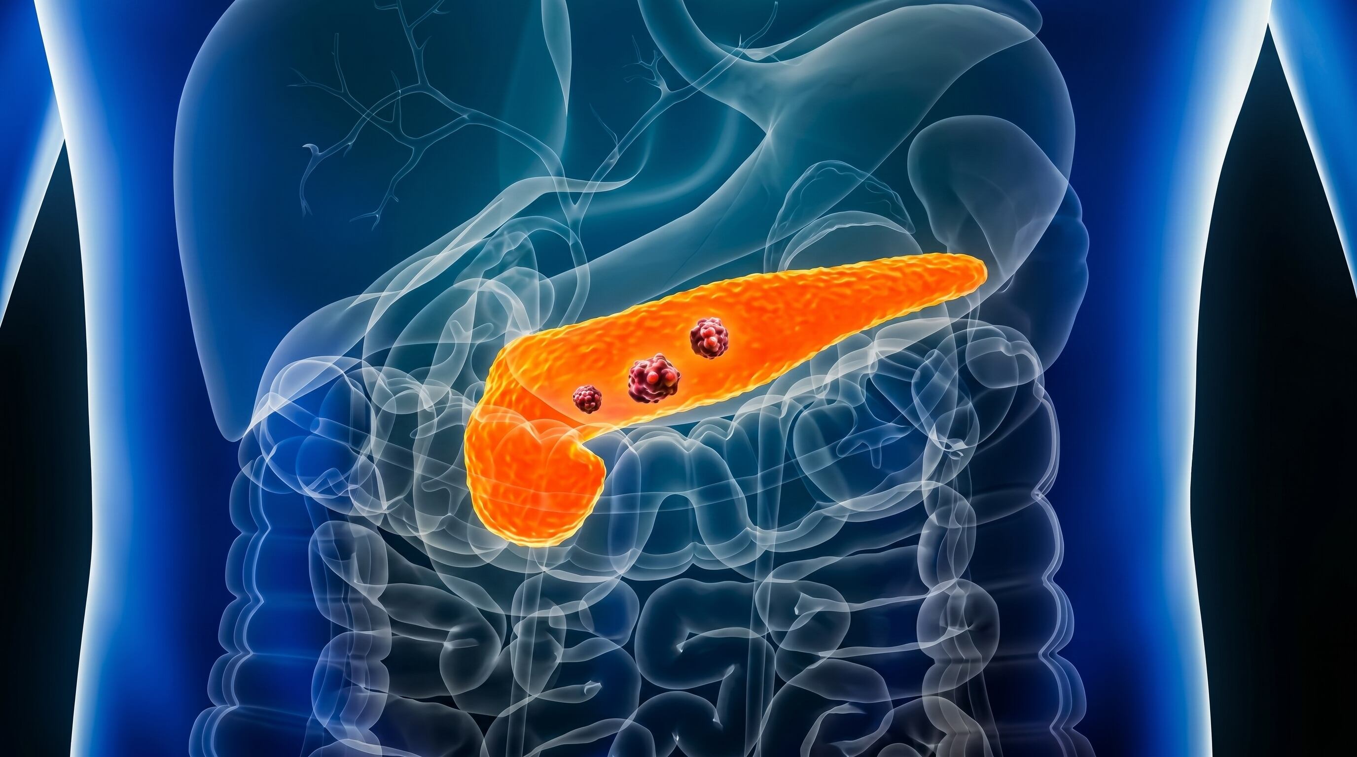 El cáncer de páncreas es el tercer tipo de tumor más mortal a nivel mundial y resiste a la mayoría de los tratamientos actuales (Imagen Ilustrativa Infobae)